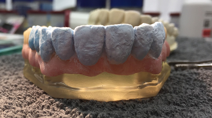 Auftrag der entgültigen Zahnform mit aufhellenden, inzisierenden und transparenten Massen
