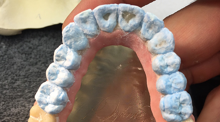 Auftrag der Zahnform mit aufhellenden, inzisierenden und transparenten Massen