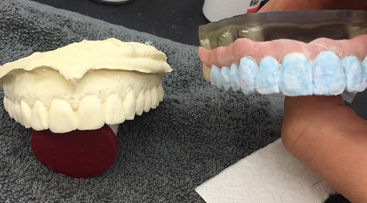 Vergleich der Zahnform mit dem Situationsmodel des Patienten